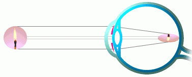 Astigmatismo