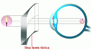 Correccion astigmatismo