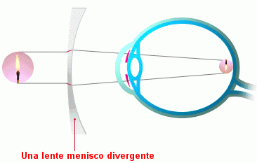 Correccion miopia
